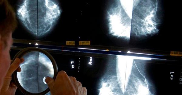 nl的15名患者需要随访，因为数千例乳房x光检查仍在继续